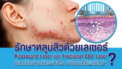 รักษาหลุมสิวด้วยเลเซอร์ Picosecond Laser และ Fractional CO2 Laser มีเทคนิคต่างกันอย่างไร ชนิดไหนได้ผลดีกว่า?